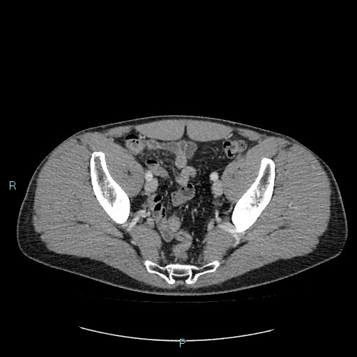 Adrenal cystic lymphangioma (Radiopaedia 83161-97534 Axial C+ portal venous phase 83).jpg