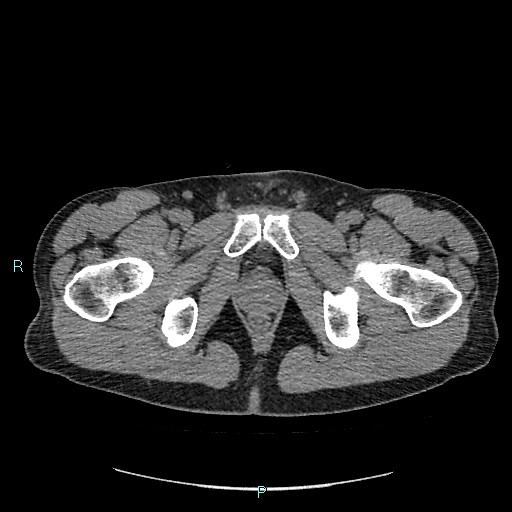 Adrenal cystic lymphangioma (Radiopaedia 83161-97534 Axial non-contrast 101).jpg