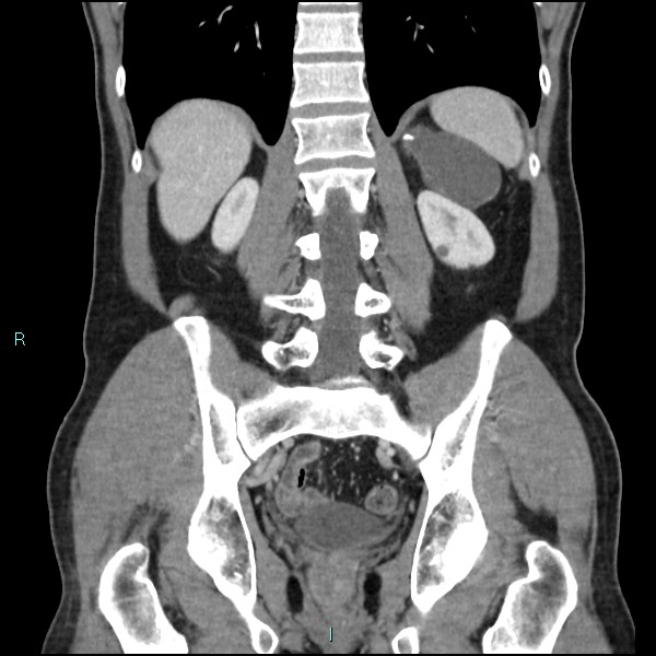 Adrenal cystic lymphangioma (Radiopaedia 83161-97534 Coronal C+ portal venous phase 53).jpg