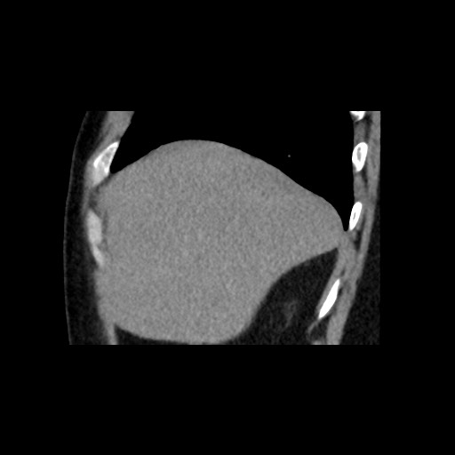Adrenal gland trauma (Radiopaedia 81351-95079 Sagittal non-contrast 17).jpg