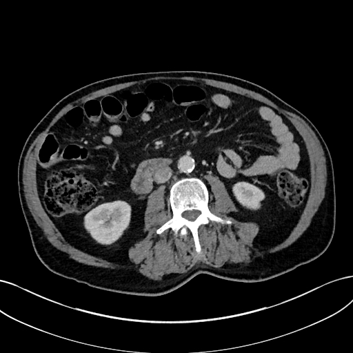 Adrenal lymphoma (Radiopaedia 73730-84529 Axial C+ portal venous phase 62).jpg