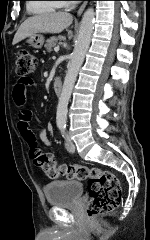 Adrenal lymphoma (Radiopaedia 73730-84529 Sagittal C+ portal venous phase 59).jpg