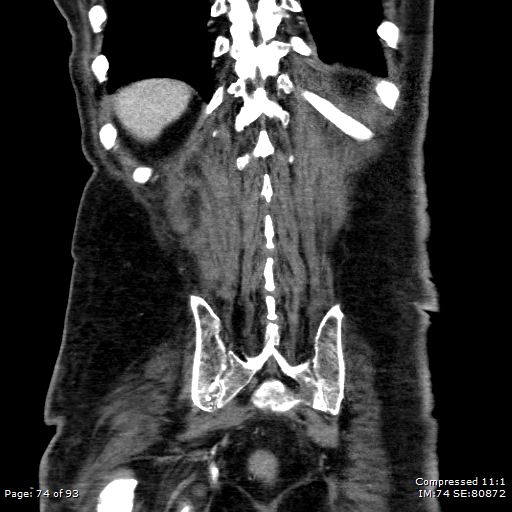 Adrenal metastasis (Radiopaedia 78425-91079 Sagittal C+ portal venous phase 61).jpg