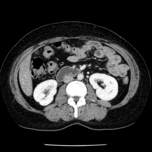 Adrenal myelolipoma (Radiopaedia 43401-46759 Axial C+ portal venous phase 41).jpg