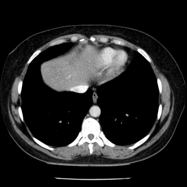 Adrenal myelolipoma (Radiopaedia 43401-46759 Axial C+ portal venous phase 6).jpg