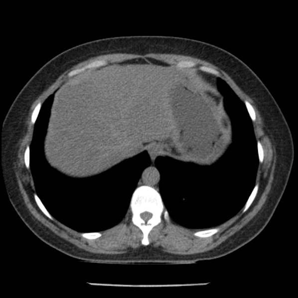 Adrenal myelolipoma (Radiopaedia 43401-46759 Axial non-contrast 11).jpg