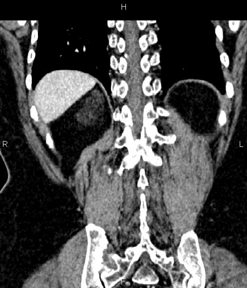 Adrenal myelolipoma (Radiopaedia 82742-96986 Coronal renal cortical phase 62).jpg