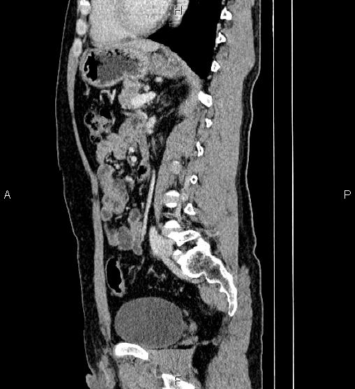 Adrenal myelolipoma (Radiopaedia 87794-104246 Sagittal renal cortical phase 57).jpg