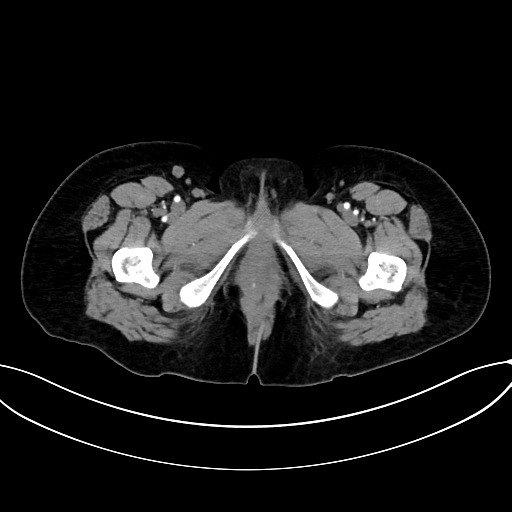 Adrenocortical carcinoma (Radiopaedia 87281-103569 Axial C+ arterial phase 94).jpg