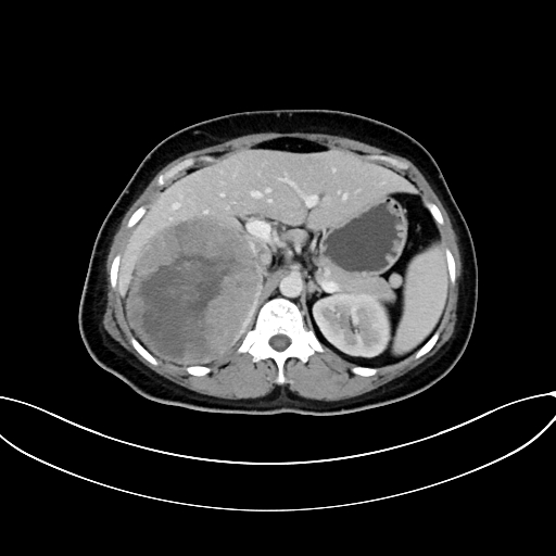 Adrenocortical carcinoma (Radiopaedia 87281-103569 Axial C+ portal venous phase 28).jpg