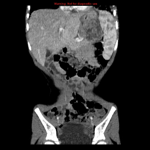 File:Adrenocortical carcinoma (Radiopaedia 9449-10131 Coronal C+ portal venous phase 2).jpg