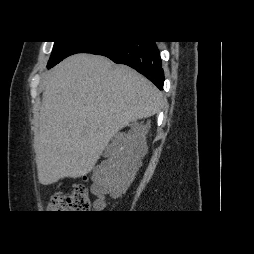 Adult polycystic kidney disease (Radiopaedia 59075-66368 Sagittal non-contrast 4).jpg