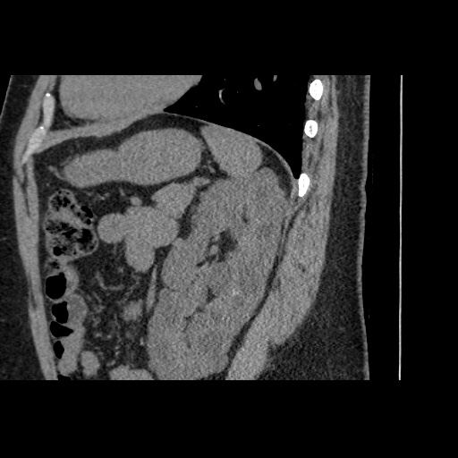 Adult polycystic kidney disease (Radiopaedia 59075-66368 Sagittal non-contrast 65).jpg