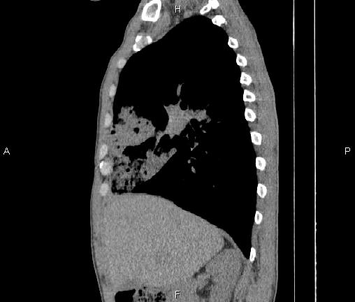 File:Air bronchogram in pneumonia (Radiopaedia 85719-101512 F 34).jpg