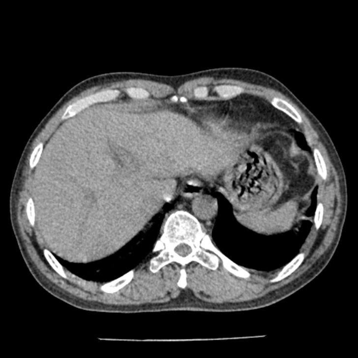 Airway foreign body in adult (Radiopaedia 85907-101779 Axial liver window 173).jpg