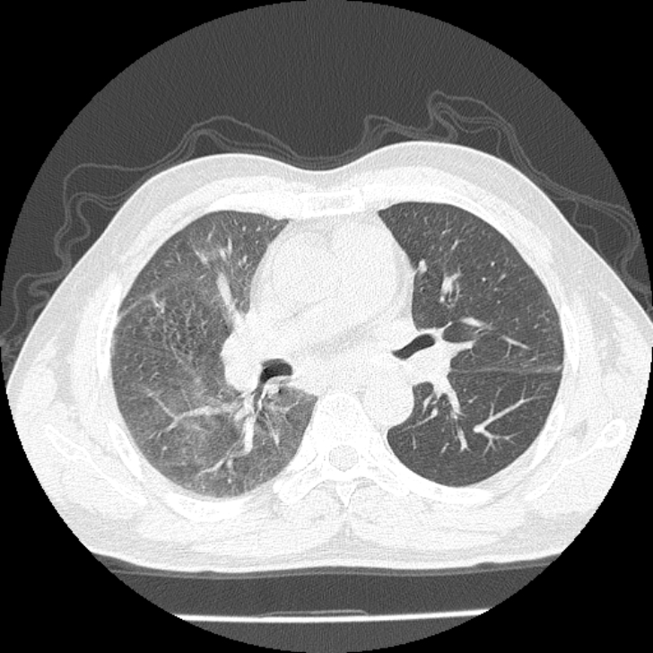 Airway foreign body in adult (Radiopaedia 85907-101779 Axial lung window 75).jpg
