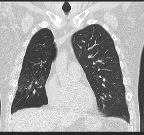 Allergic bronchopulmonary aspergillosis (Radiopaedia 44760-48571 Coronal lung window 22).png