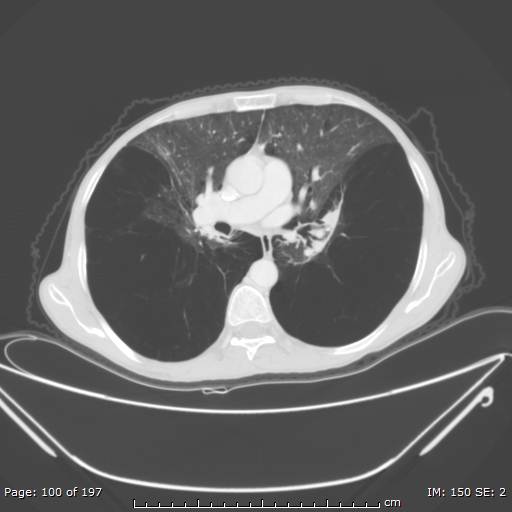 Alpha-1-antitrypsin deficiency (Radiopaedia 50561-55987 Axial lung window 42).jpg