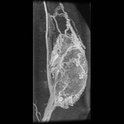 Alveolar soft part sarcoma (Radiopaedia 64501-73678 D 20).jpg
