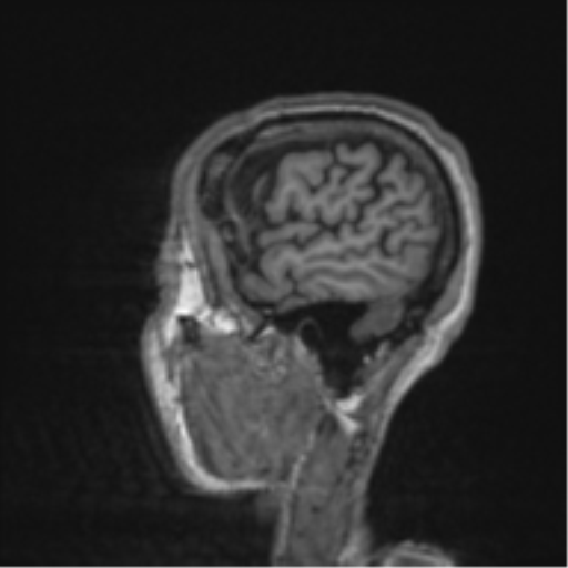 File:Alzheimer's disease- with apraxia (Radiopaedia 54763-61011 Sagittal T1 8).png