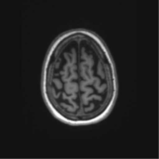 File:Alzheimer's disease (Radiopaedia 42658-45802 Axial T1 29).png