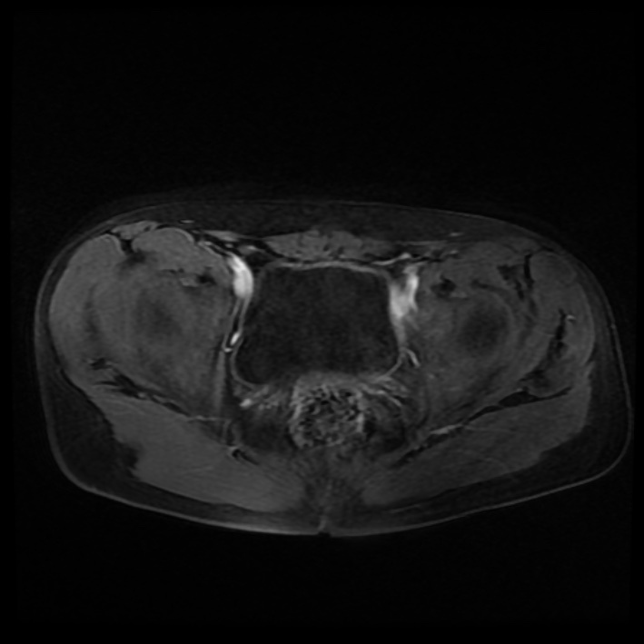 Ambiguous genitalia (Radiopaedia 69686-79643 Axial T1 C+ fat sat 30).jpg