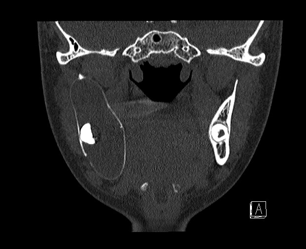 File:Ameloblastoma (Radiopaedia 26645-26793 bone window 15).jpg