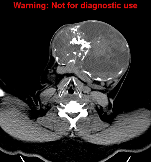 File:Ameloblastoma (Radiopaedia 33126-34164 A 22).jpg