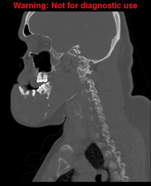Ameloblastoma (Radiopaedia 33126-34164 Sagittal bone window 48).jpg