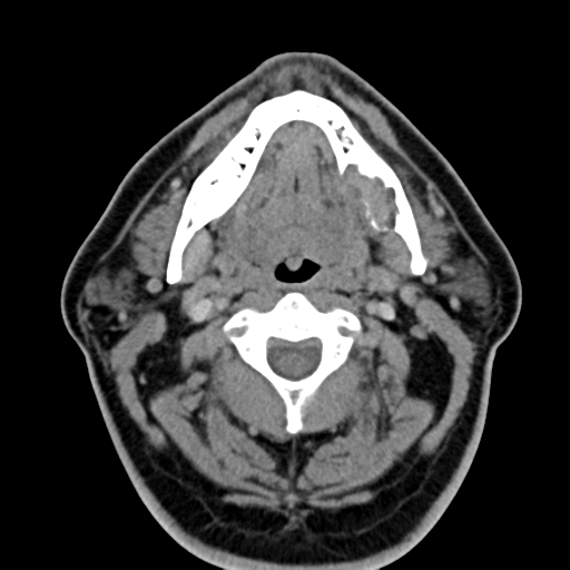 Ameloblastoma (Radiopaedia 38520-40623 Axial non-contrast 32).png
