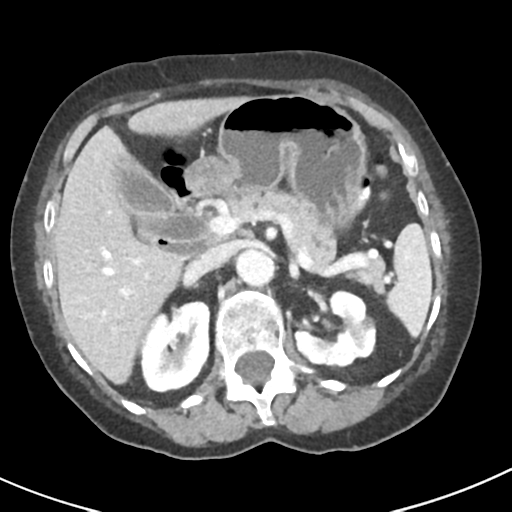 Ampullary adenocarcinoma (Radiopaedia 34013-35237 C 14).png