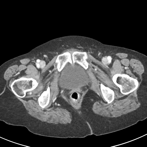 Ampullary adenocarcinoma (Radiopaedia 34013-35237 C 58).png