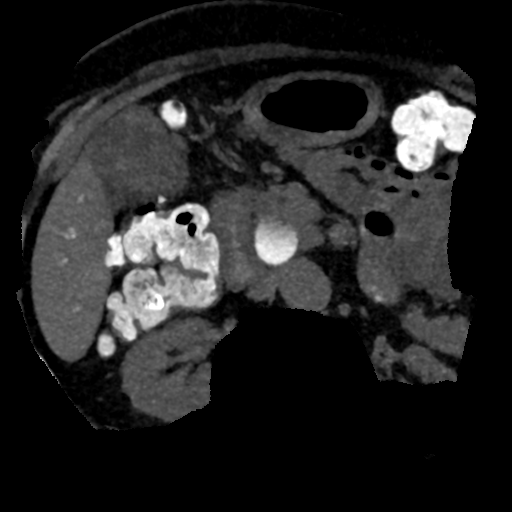 Ampullary adenocarcinoma (Radiopaedia 34013-35241 AXIAL MIPS 3-1.5 66).png