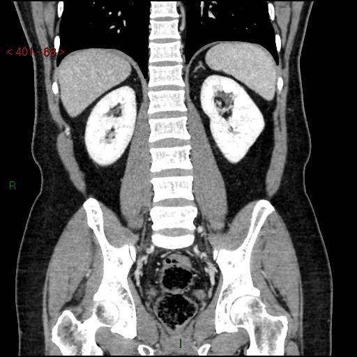 Ampullary carcinoma (Radiopaedia 56396-63056 E 67).jpg