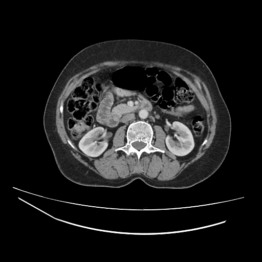Ampullary tumor (Radiopaedia 60333-67998 A 36).jpg