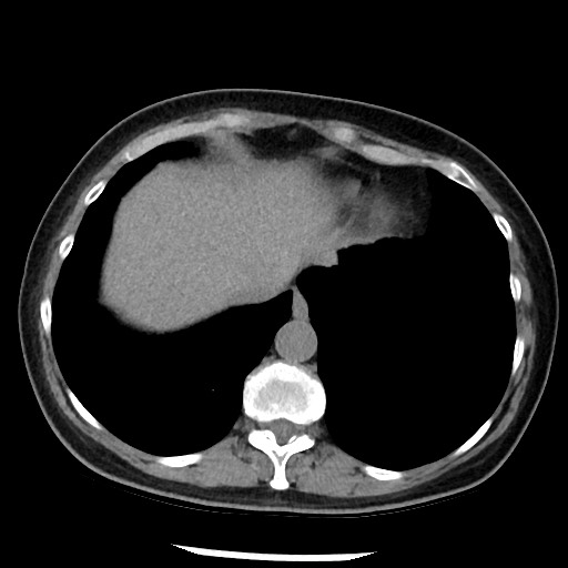 Amyloidosis - bronchial and diffuse nodular pulmonary involvement (Radiopaedia 60156-67744 Axial non-contrast 47).jpg