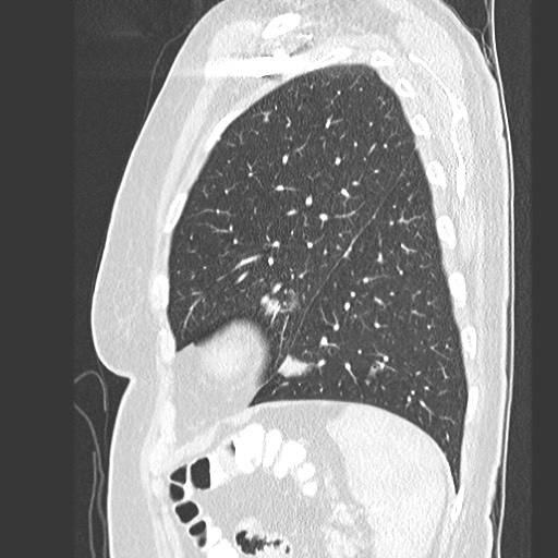 File:Amyloidosis - bronchial and diffuse nodular pulmonary involvement (Radiopaedia 60156-67745 Sagittal lung window 73).jpg