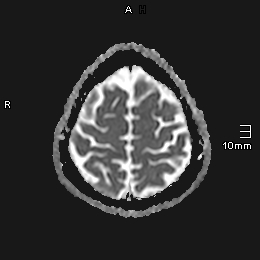 File:Amyotrophic lateral sclerosis (Radiopaedia 70821-81017 Axial ADC 19).jpg