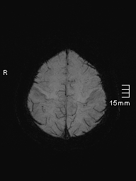 File:Amyotrophic lateral sclerosis (Radiopaedia 70821-81017 Axial SWI minIP 42).jpg