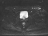 Anal adenocarcinoma - tumor regression grade 1 (Radiopaedia 31358-32101 Axial DWI 43).jpg