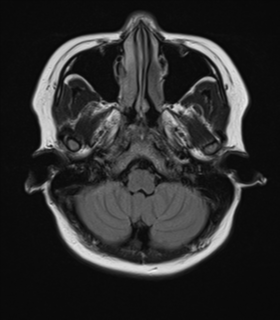 File:Anaplastic astroblastoma (Radiopaedia 55666-62194 Axial FLAIR 5).png