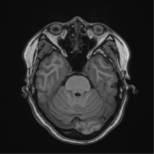Anaplastic astroblastoma (Radiopaedia 55666-62194 Axial T1 23).png