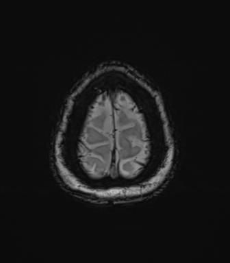 Anaplastic astrocytoma (Radiopaedia 86943-103160 Axial SWI 83).png