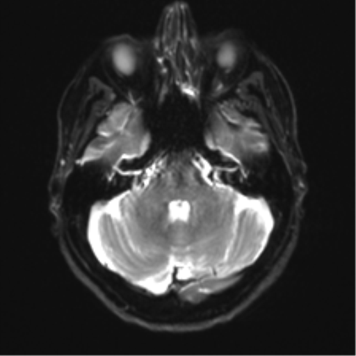 Anaplastic astrocytoma - thalamic glioma (Radiopaedia 59709-67115 Axial DWI 9).png
