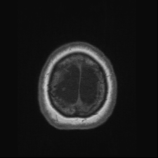 Anaplastic astrocytoma IDH wild-type (pseudoprogression) (Radiopaedia 42209-45276 Axial T1 140).png