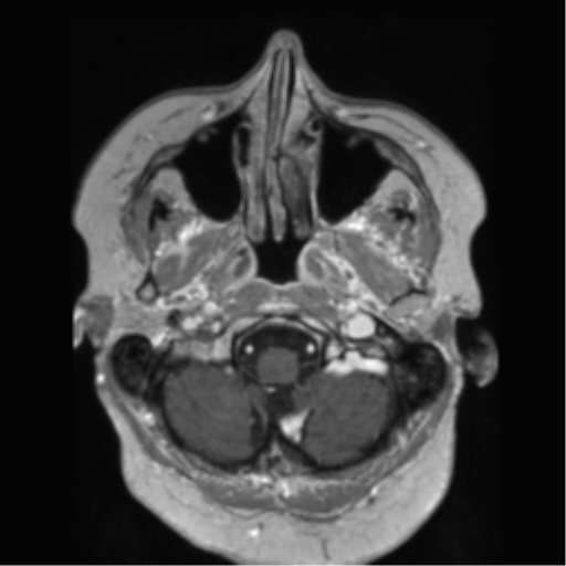 File:Anaplastic astrocytoma IDH wild-type (pseudoprogression) (Radiopaedia 42209-45278 Axial T1 C+ 29).png