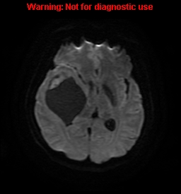 File:Anaplastic ganglioglioma (Radiopaedia 44921-48831 Axial DWI 14).jpg