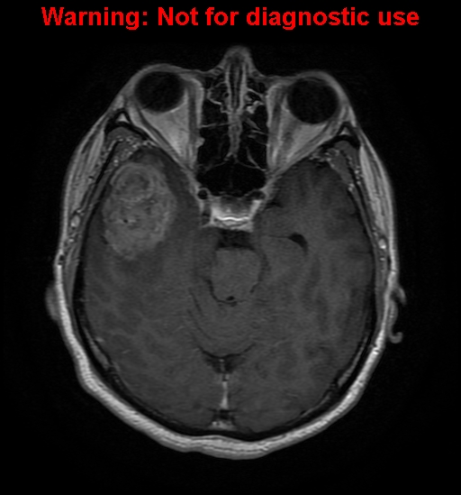 File:Anaplastic ganglioglioma (Radiopaedia 44921-48831 Axial T1 C+ 11).jpg
