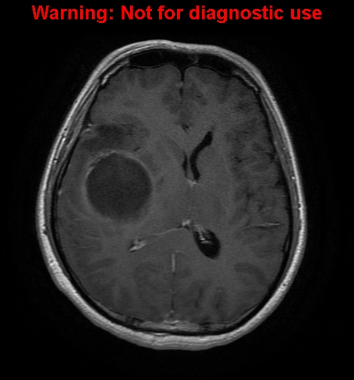 File:Anaplastic ganglioglioma (Radiopaedia 44921-48831 Axial T1 C+ 18).jpg