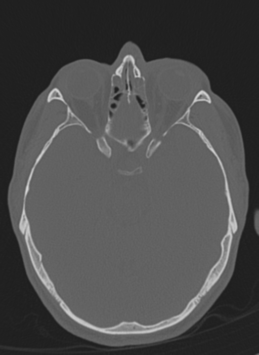 Anaplastic oligodendroglioma with skull fracture (Radiopaedia 74831-85846 Axial bone window 47).png